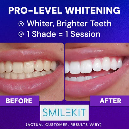 DiamondSeries- Snow Teethwhitening™ Kit with Hydroxyapatite & Potassium Nitrate - 10 serums