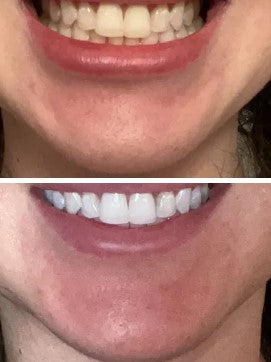 Snow Teeth Whitening Kit – LED Light Activated Smile Whitening System | Safe, Effective, and Fast Results